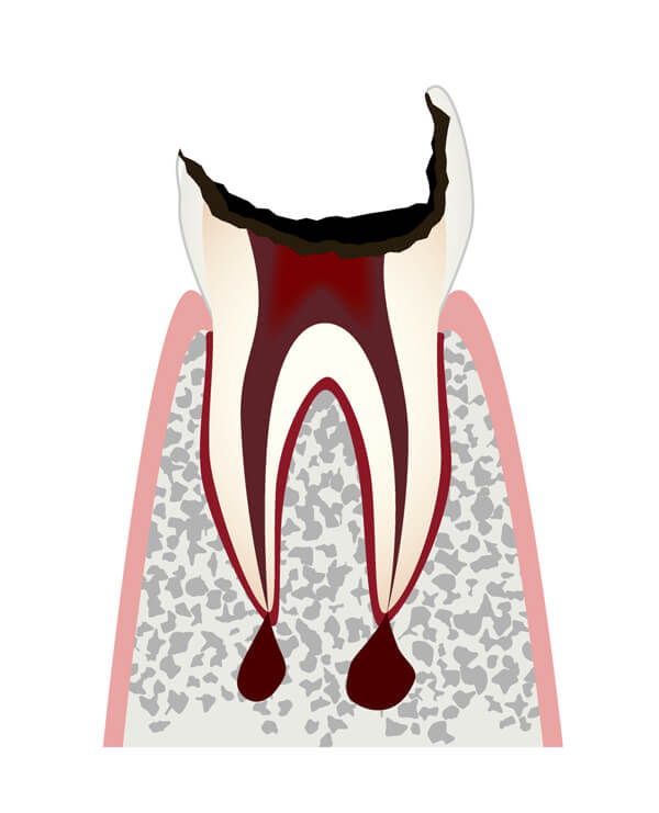 歯の根（歯質）が失われた歯